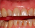 Blanqueamiento dental