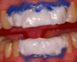Blanqueamiento dental
