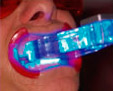 Blanqueamiento dental