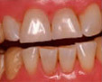 Blanqueamiento dental